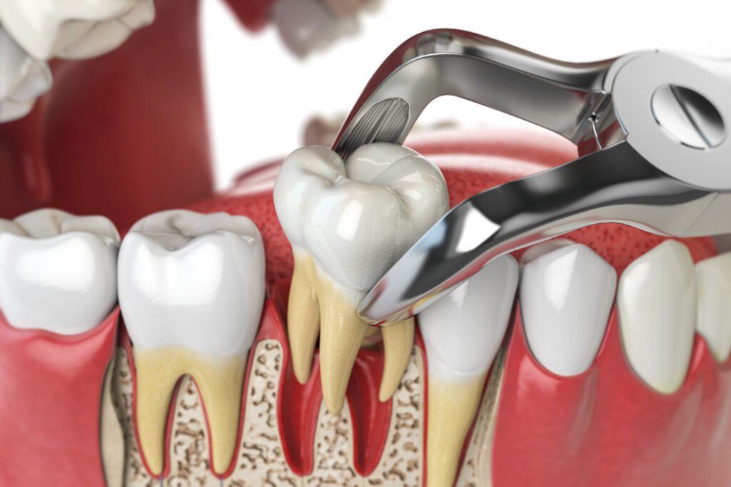 Tooth Extractions - Viera Dental Arts | Dentist in Melbourne FL