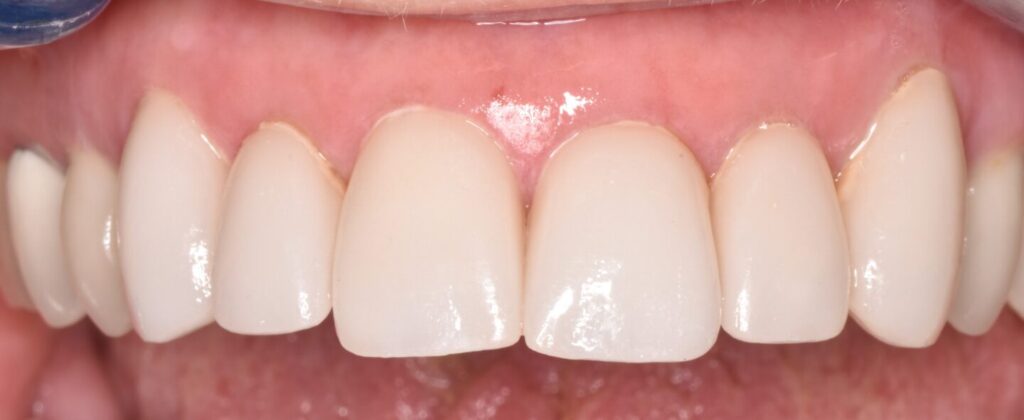 Before And After - Viera Dental Arts | Dentist in Melbourne FL - Viera Dental Arts | Dentist in Melbourne FL -
