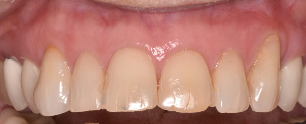 Before And After - Viera Dental Arts | Dentist in Melbourne FL - Viera Dental Arts | Dentist in Melbourne FL -
