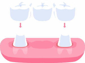 Dental Blog - Viera Dental Arts | Dentist in Melbourne FL - Traditional dental bridges teeth illustration design. Dental care concept.