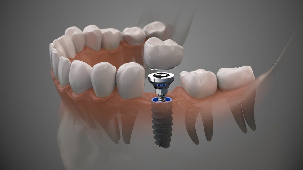 Tooth human implant. On1 concept. Dental prosthetic innovation.
