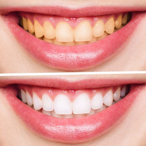 A comparative image clearly showcasing the noticeable difference in teeth color following the whitening treatment