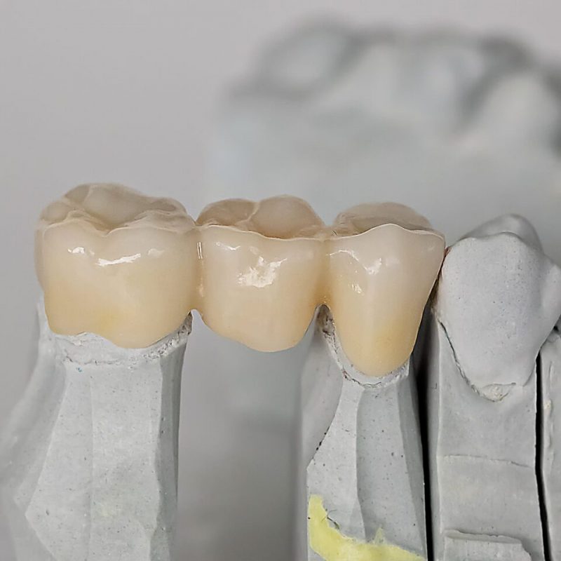Close-up of a dental bridge spanning teeth 5 and 7, showcasing detailed prosthetic work. Concept of dental restoration, fixed bridge, and oral health care.
