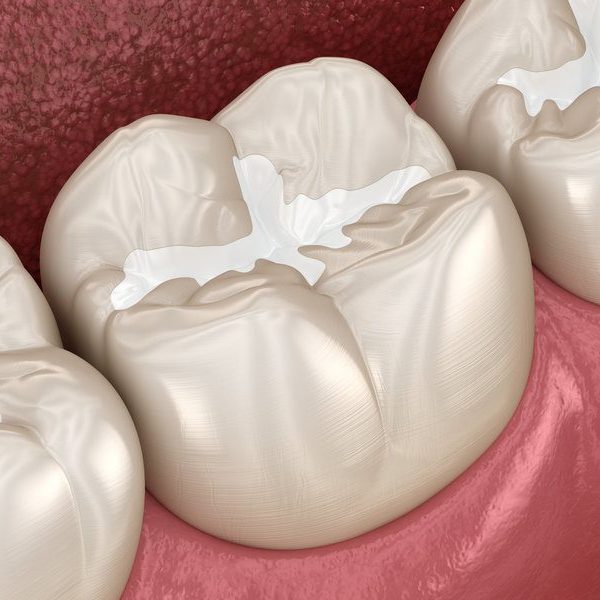 Molar Fissure dental fillings, Medically accurate 3D illustration of dental concept