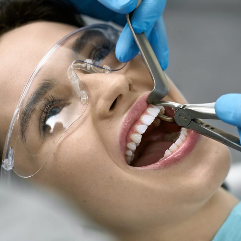 Poor girl in a patient's bib and protective glasses in a dental clinic. Dentist in blue latex gloves is removing her tooth with a help of a cheek retractor and forceps. Closeup horizontal photo.