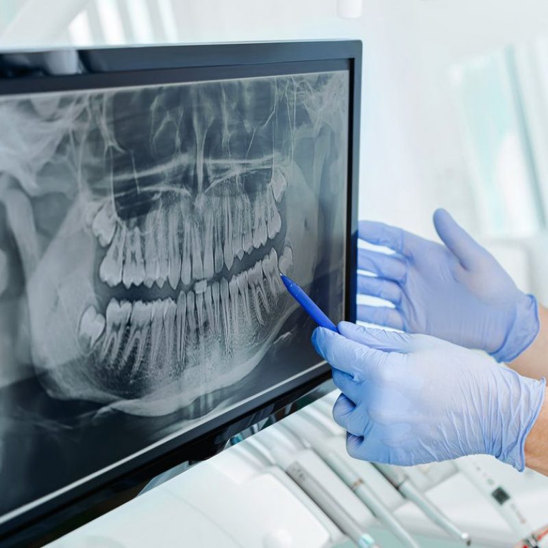 Hands doctor dentist in gloves show the teeth on x-ray on digital screen in dental clinic on light background with medical equipment. Smile healthy teeth concept, close up
