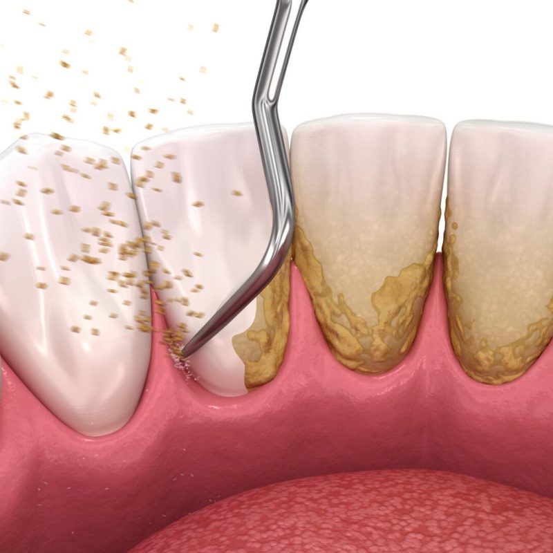 Oral hygiene: Scaling and root planing (conventional periodontal therapy). Medically accurate 3D illustration of human teeth treatment