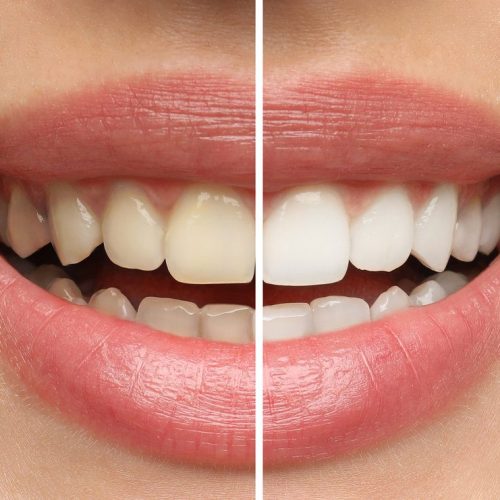 Collage with photos of woman before and after teeth whitening, c Collage with photos of woman before and after teeth whitening, closeup