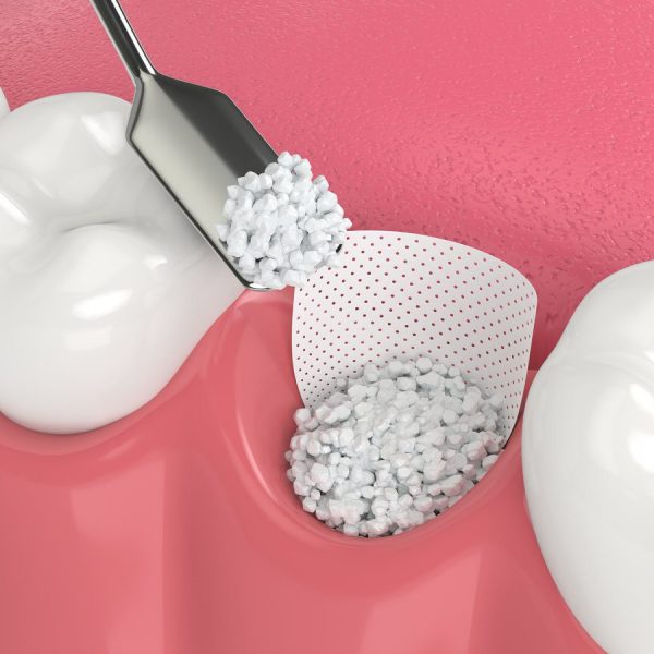 3D render of dental bone grafting with bone biomaterial and membrane over white background. Jaw bone augmentation concept.
