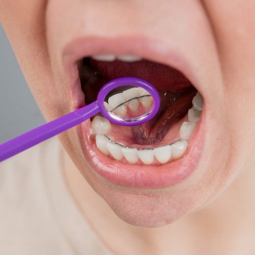 Close-up portrait of a woman with internal braces and a dental mirror. The girl corrects the bite.