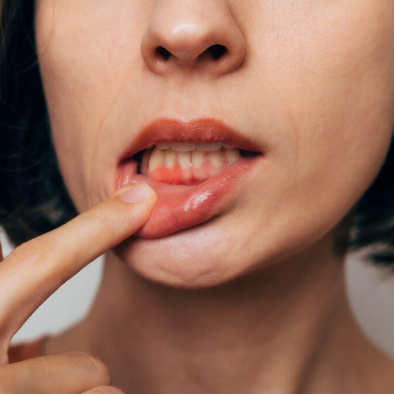 Close up shot of gum inflammation. Cropped shot of a young woman showing red bleeding gums isolated on a gray background. Dentistry, dental care