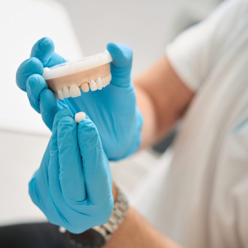 Cropped photo of dentist in disposable nitrile gloves holding dental crown and maxillary teeth model