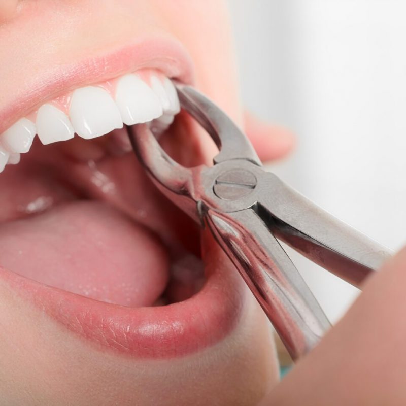 Removing the sick tooth from girls mouth